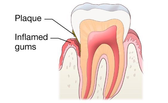 germs in the teeth and tongue